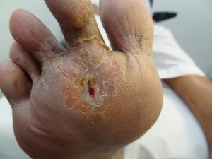 Diabetic foot ulcer