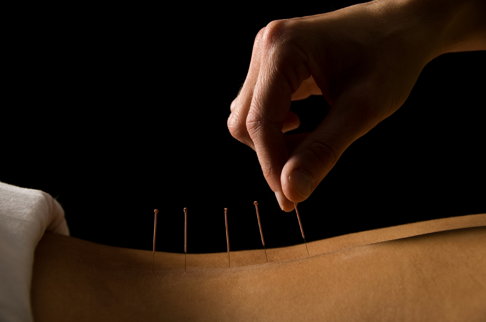 Acupuncture