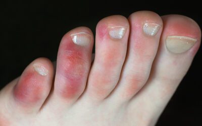 Compare covid toes with chillblains