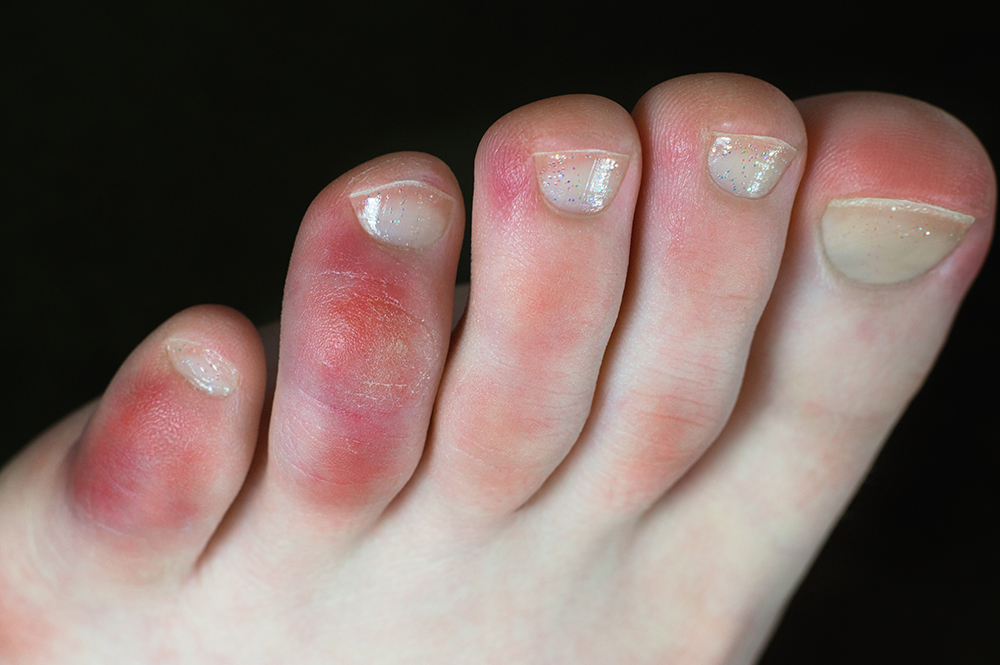 Compare covid toes with chillblains