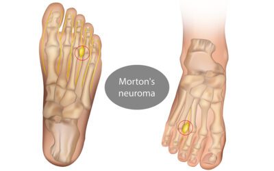 How to relieve Morton’s Neuroma