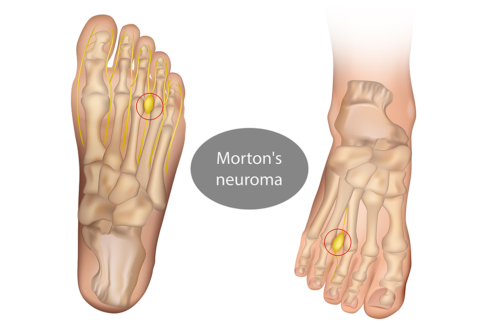 How to relieve Morton’s Neuroma